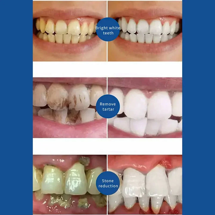Quick Repair Cavities Caries Whitening Teeth